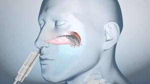 neoplasia